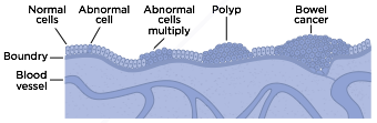 colonoscopy