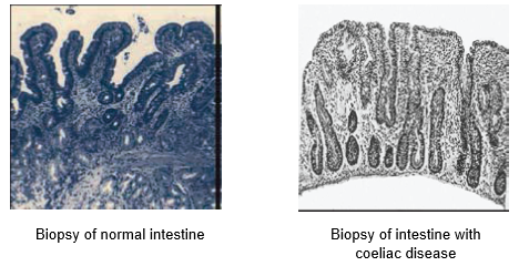 coeliac disease